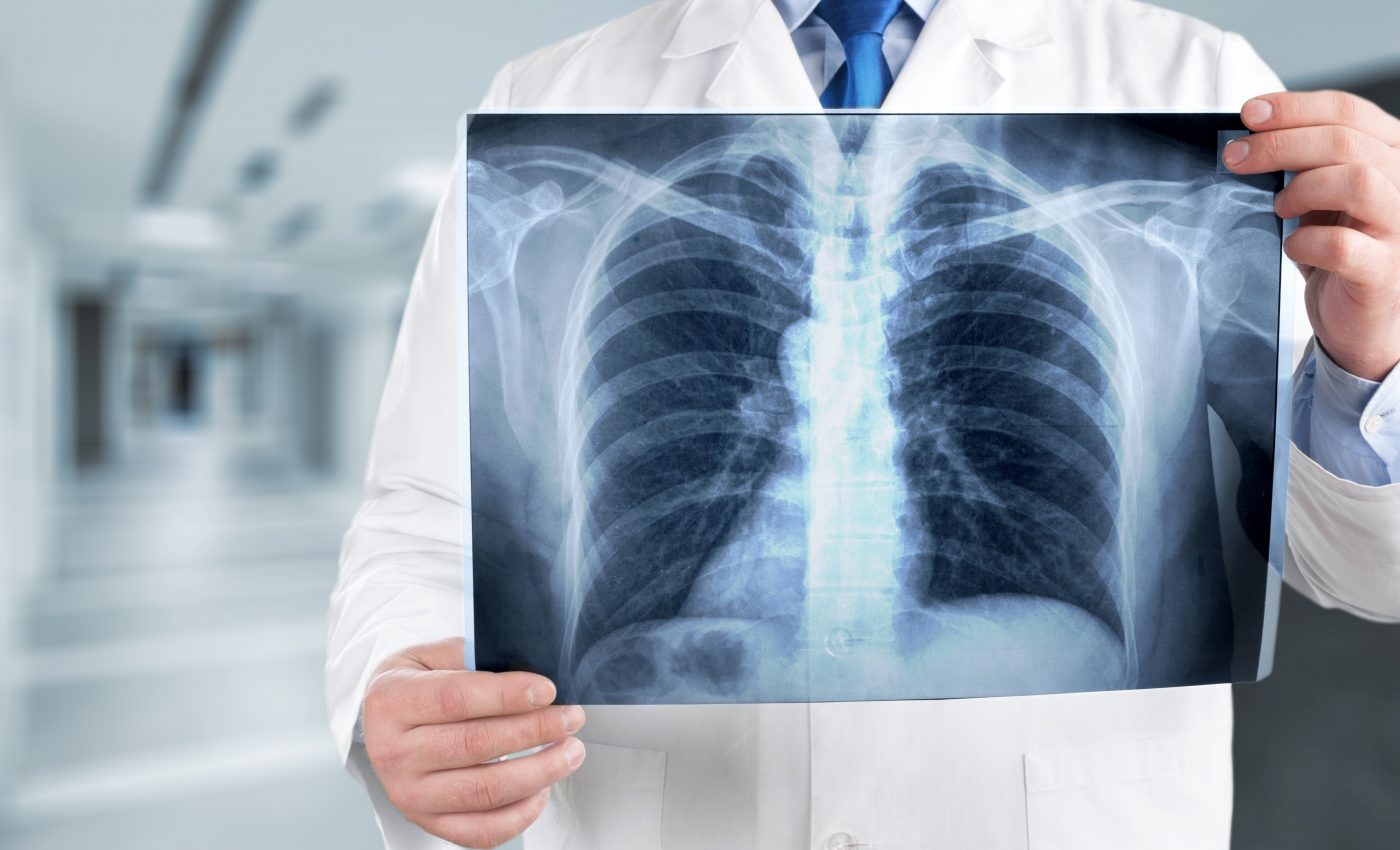 Cancer patients have a higher risk of fatal COVID-19 infection