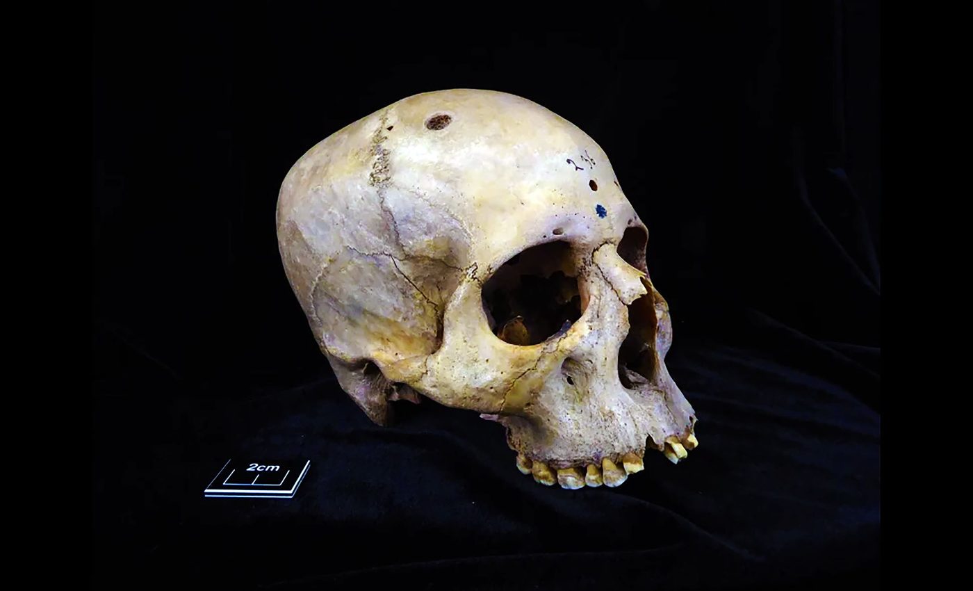 4000-year-old skulls reveal ancient Egyptian attempts at cancer treatment