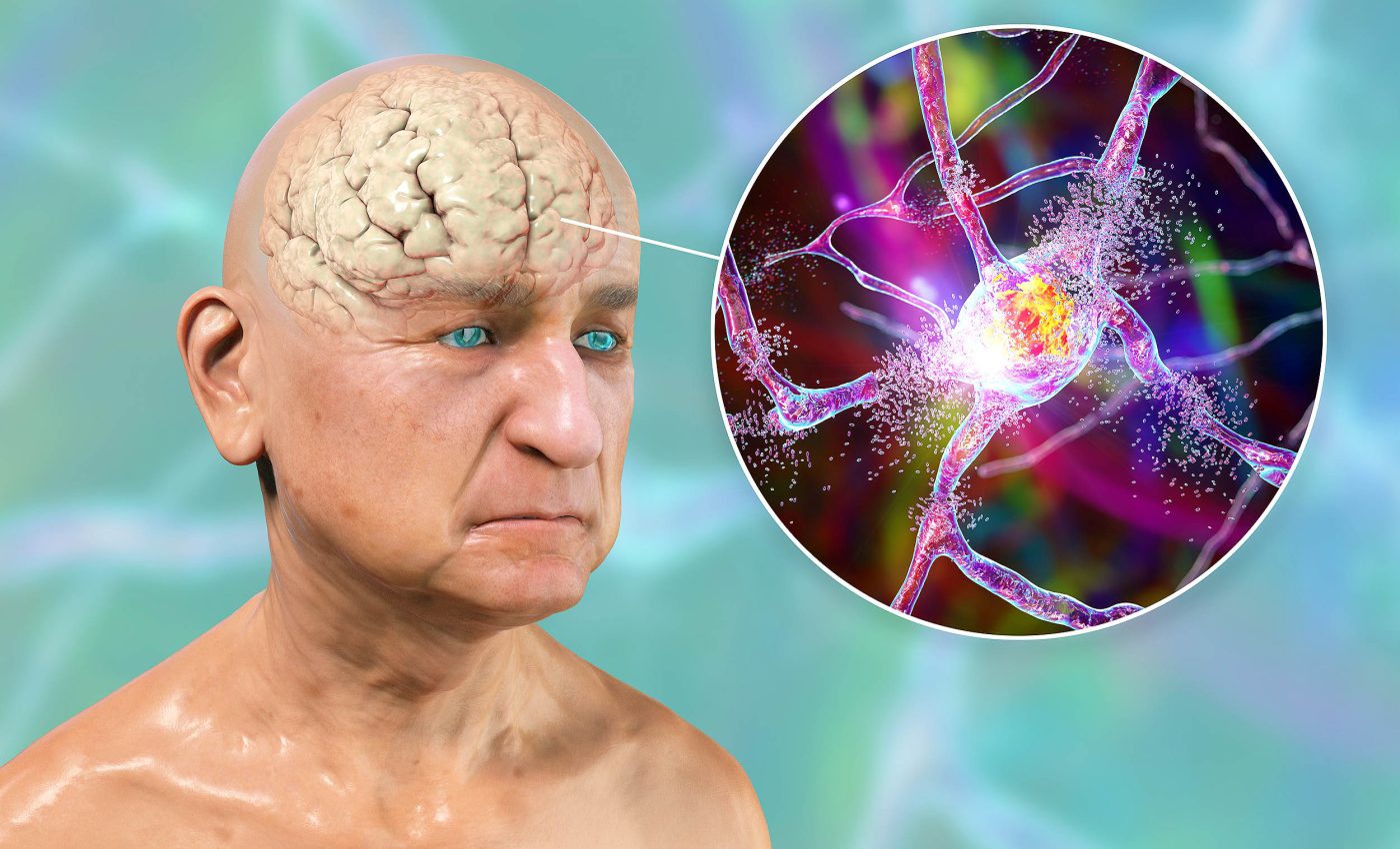 Alzheimer's may not be a brain disorder, important data was fabricated